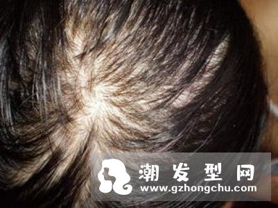 夏天头发油怎么办 做好这三点头发干爽飘逸