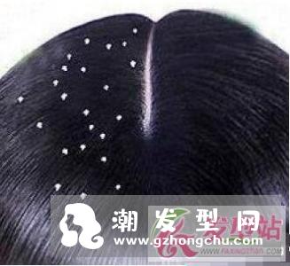 头皮屑多是什么原因 如何有效的去除头皮屑