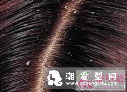 头皮屑多是什么原因 如何有效的去除头皮屑