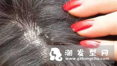 头皮屑多是什么原因 如何有效的去除头皮屑