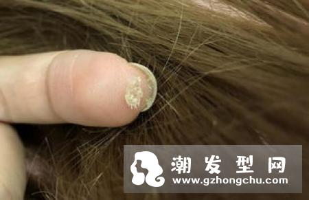 除头螨的洗发水有哪些 最简单的去头螨方法