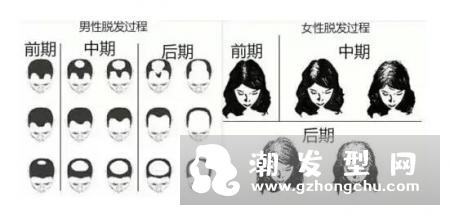 脂溢性脱发洗发水 洗发水真的治疗脂溢性脱发吗