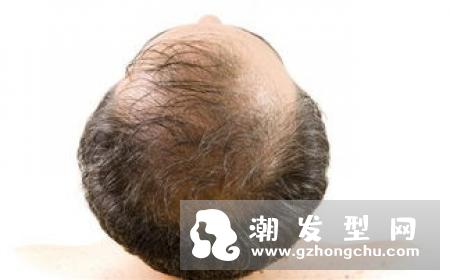 治疗脱发偏方 找对方法治疗脱发一针见血