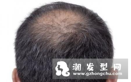 生发黑豆汤适合哪种脱发 一天喝几次