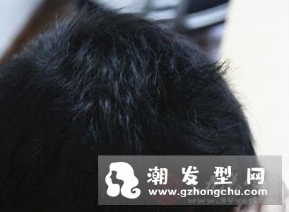 头屑是怎么形成的为什么难去除 头皮屑治疗小窍门