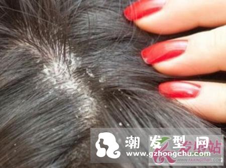 头皮屑多是什么原因 如何有效的去除头皮屑