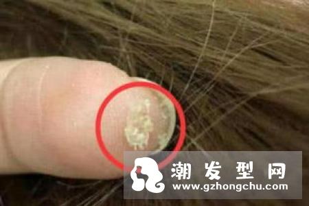 头皮上抠出白色小颗粒是什么东西 头发根部有白色颗粒怎么办