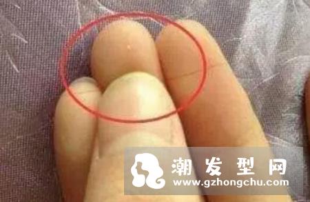 头皮上抠出白色小颗粒是什么东西 头发根部有白色颗粒怎么办
