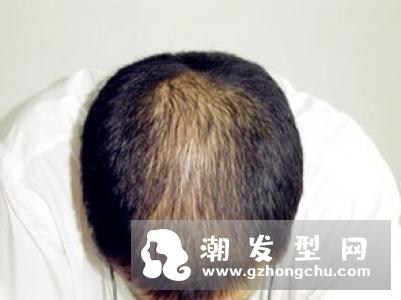 90后踏入脱发大军 脱发原因及护理技巧