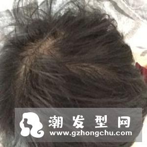 洗头发掉头发怎么办 洗头发掉多少头发正常