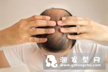 预防脱发不能忽视的误区 如何判断自己是正常脱发