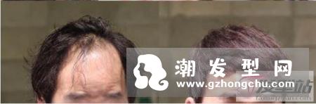 髮簪烫拯救各种秃头困扰 头发稀少秃头男士最佳烫发