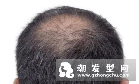脂溢性脱发洗发水 洗发水真的治疗脂溢性脱发吗