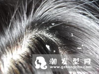 头皮屑多是什么原因 如何有效的去除头皮屑