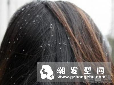 头皮屑特别多怎么办 注意好这些头皮屑无踪影