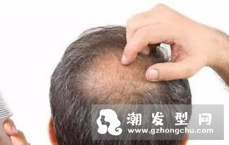 传潘婷洗发水硅油含量较高 硅油真的会导致脱发吗