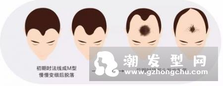 发际线越来越后移 什么原因导致掉发