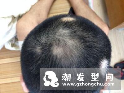 洗头发掉头发怎么办