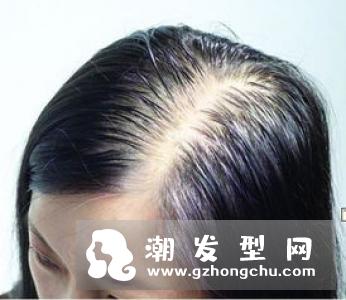 发质变差的原因有哪些 正确的洗头方法有利改善发质