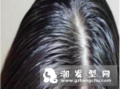 头皮痒白醋可以洗头吗 去头皮屑效果好吗