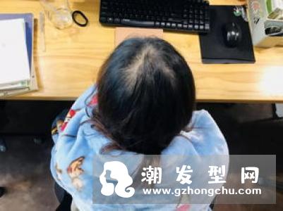 想改善脱发先从了解做起 分享有效预防掉发的五项小秘诀