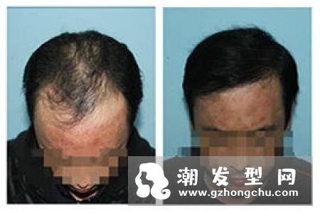 治疗脱发偏方 找对方法治疗脱发一针见血