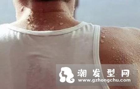 26岁女白领为减肥吃素掉头发至斑秃 斑秃治疗最快的方法