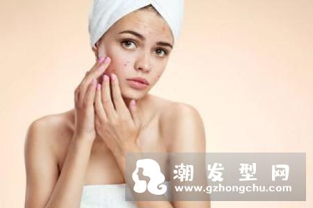 头螨不能用什么洗发水 大蒜洗头能去头螨吗