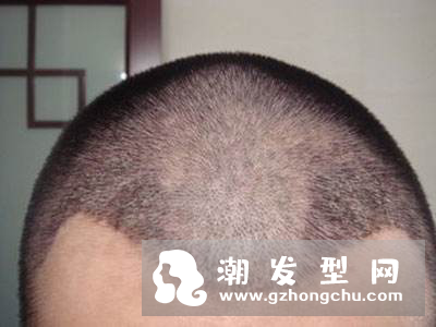 M形脱发是什么原因 一定会秃顶吗