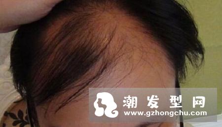 头发稀少吃什么好 有利于增发是食物都有哪些