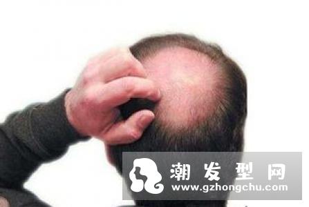 蛋白质不足会导致脱发?吃什么食物可以有效防止脱发