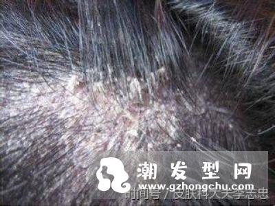 头虱是怎么来的 和头皮屑怎么区分