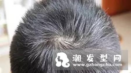 少年白头发是什么原因 头发变黑的方法有哪些