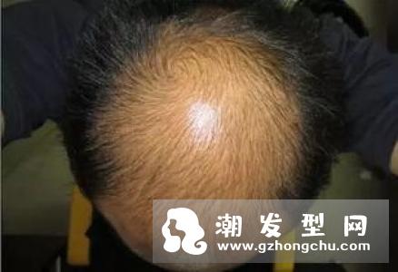 油性头发容易脱发吗 脱发怎么办