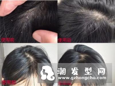 头螨不能用什么洗发水 大蒜洗头能去头螨吗