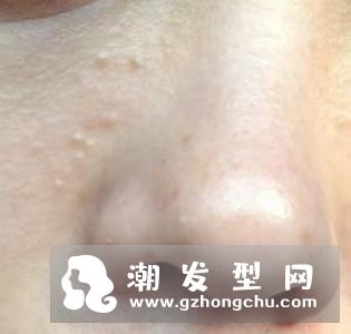 脂肪粒会不会越长越多 用针挑会留疤吗