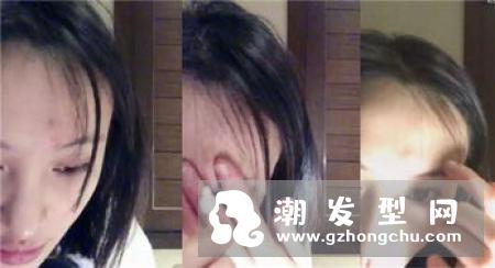 郑爽痘痘贴是什么牌子 在哪里可以买到