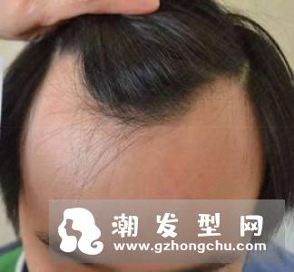 发型固定不变的危害 掉发脱发问题全解析