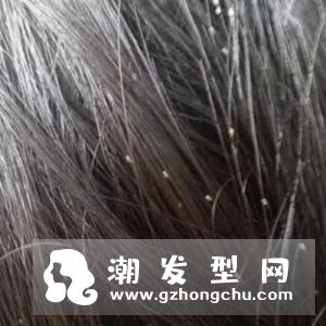 头虱是怎么来的 和头皮屑怎么区分