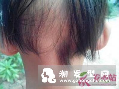 21岁漂亮女孩8年拔光了满头秀发 拔毛癖拔头发都有哪些危害？