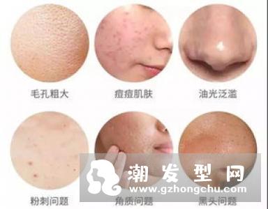 头虱的卵是白色的吗 怎么彻底去除