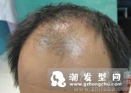 夏天为什么掉头发严重 影响夏季脱发的原因有哪些