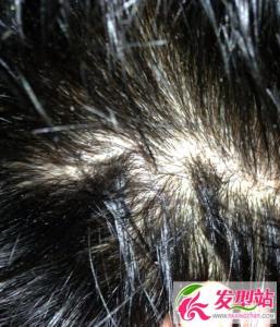 头发油头屑多怎么办 日常洗发护发小贴士