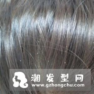 头虱是怎么来的 和头皮屑怎么区分