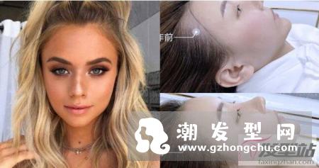 雾发际线真的安全吗？纹雾状发际线如何维持与保养？