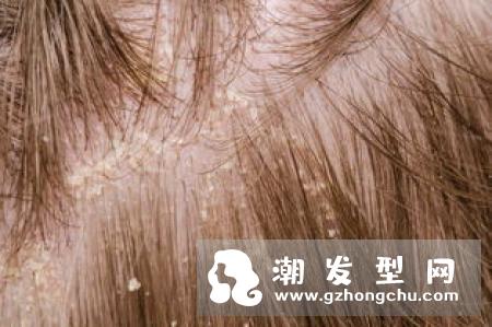 头虱是怎么来的 和头皮屑怎么区分