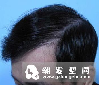 吃什么多头发好 拒绝头发干燥枯黄开叉头屑脱发食谱