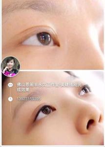 雾发际线真的安全吗？纹雾状发际线如何维持与保养？
