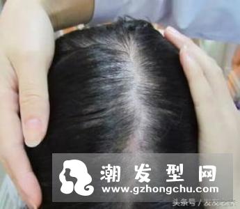 产后掉发怎么办？女性掉发原因及对策