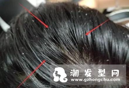 头发特别容易油怎么办 是湿气重吗